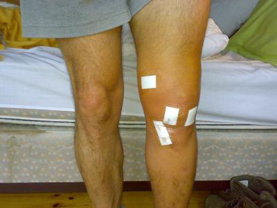 rodilla